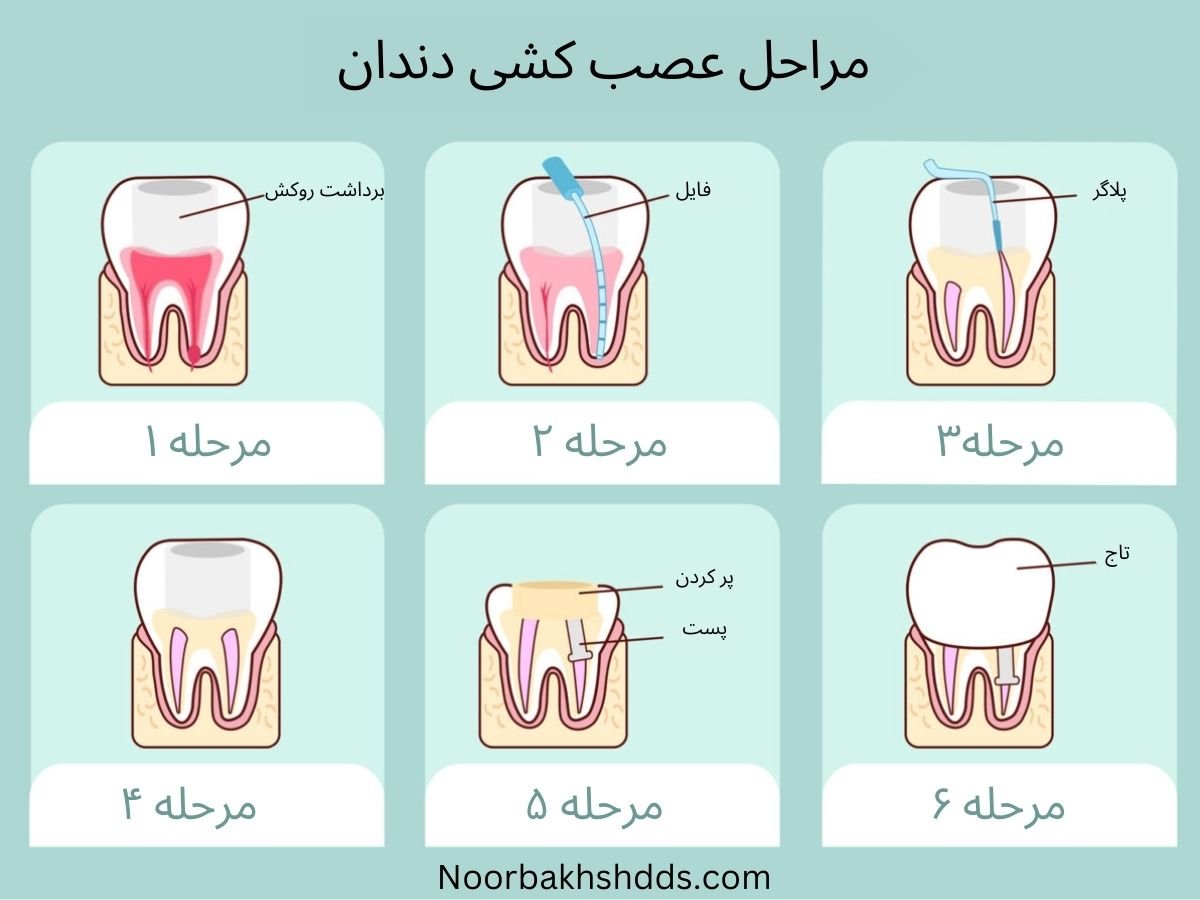 مراحل عصب کشی دندان