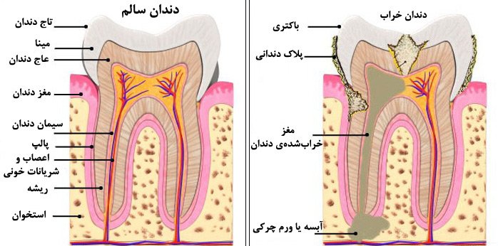 کی دندان را عصب کشی کنیم؟