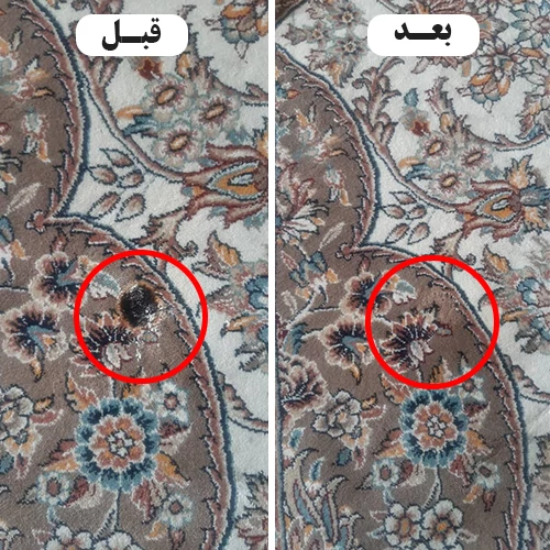 قبل و بعد از رفع سوختگی شدید در قالیشویی نگین