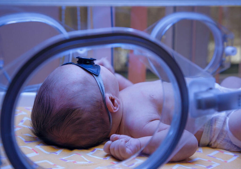 نوزاد مبتلا به بیماری زردی داخل دستگاه فتوتراپی