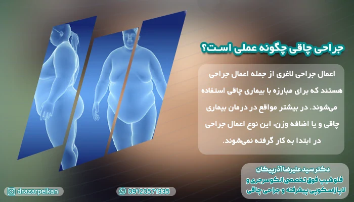 عمل جراحی چاقی چیست