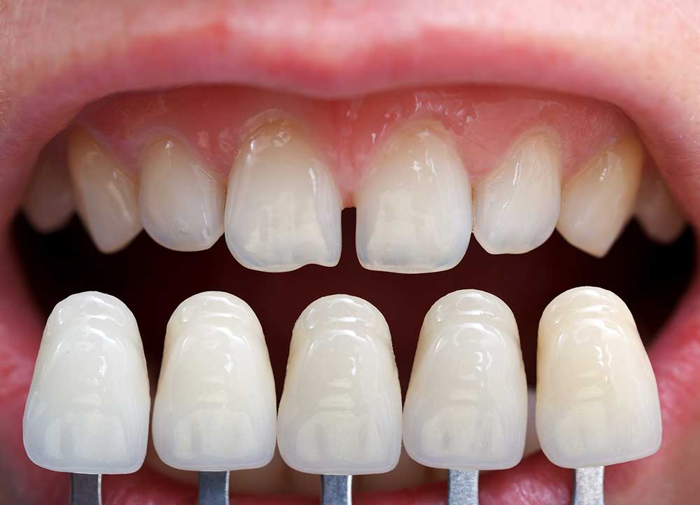 لمینت دندان مناسب چه افرادی هستند؟