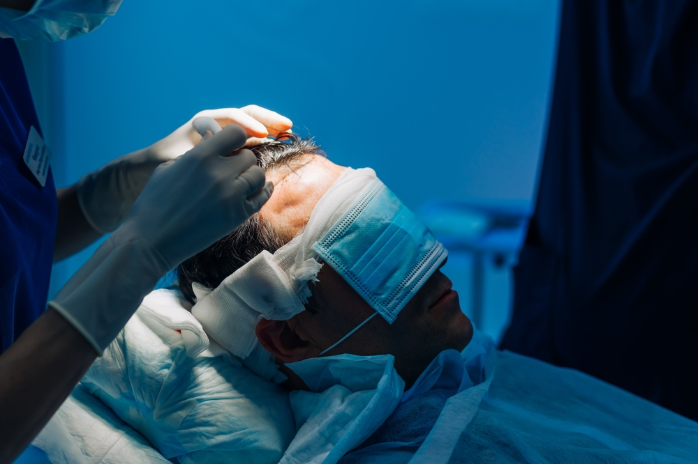 بهترین زمان برای عمل کاشت مو