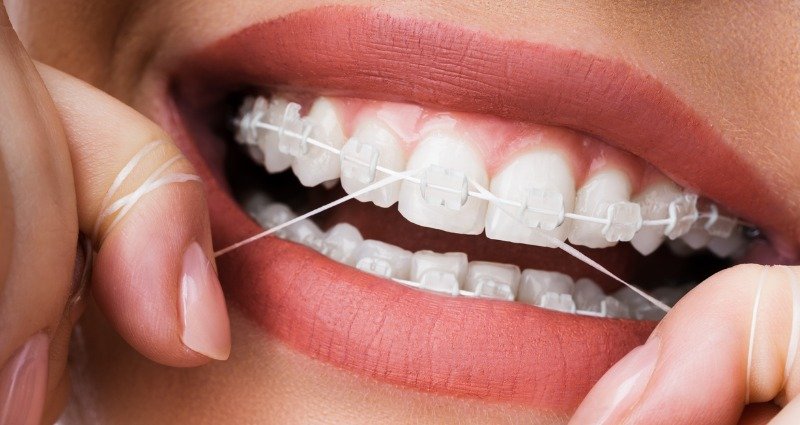 روش استفاده از نخ دندان ارتودنسی