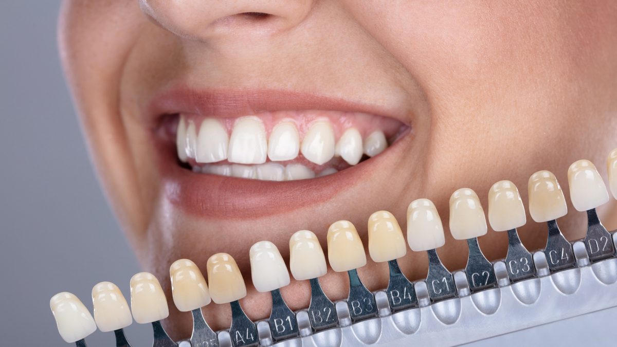 کامپوزیت دندان چیست و چگونه انجام می‌شود؟