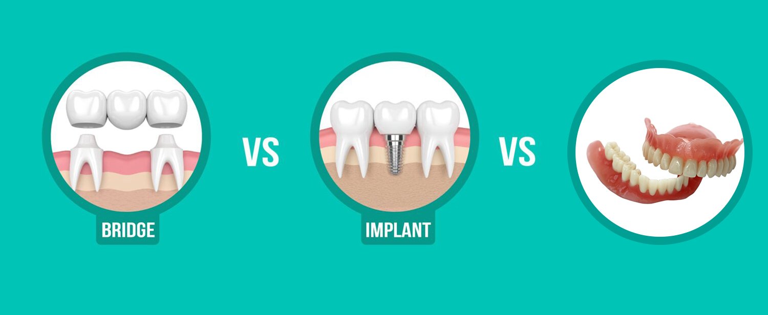 تفاوت ایمپلنت، بریج و دندان مصنوعی