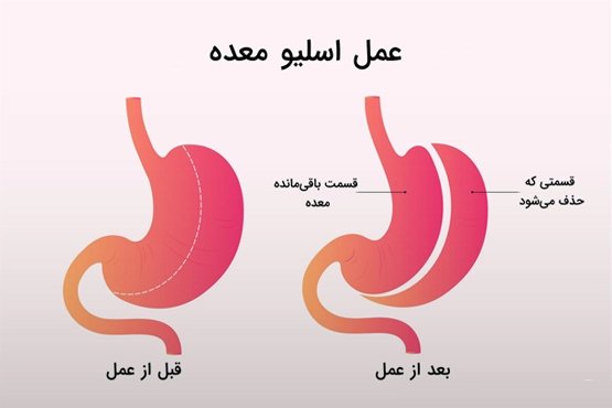 عمل اسلیو معده