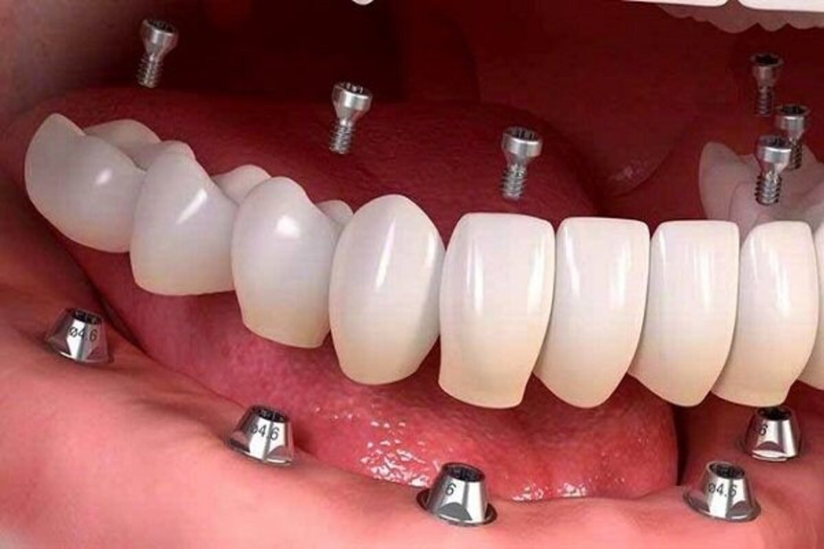 کاشت ایمپلنت دندان در مطب دکتر هومن پاک نیت