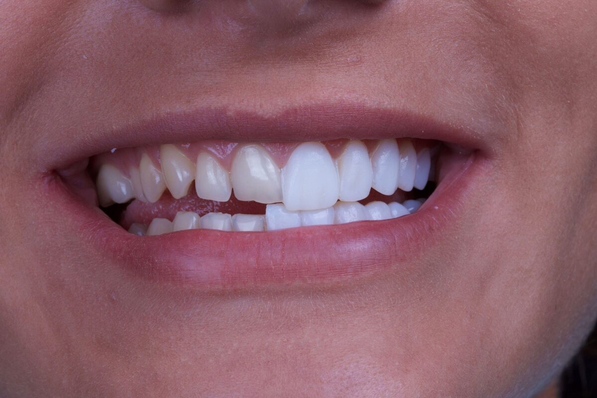 بهترین دندانپزشک لمینت دندان در تهران