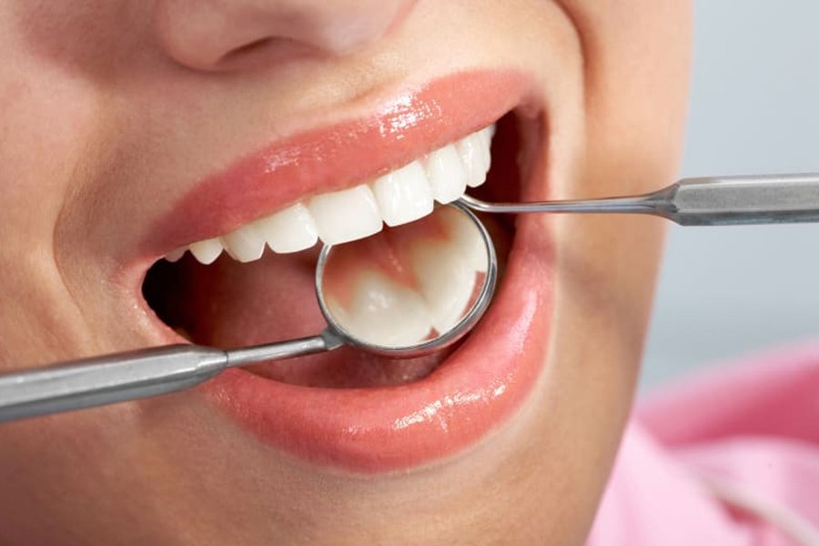 کامپوزیت دندان در کلینیک دندانپزشکی هلسا قسطی شد!