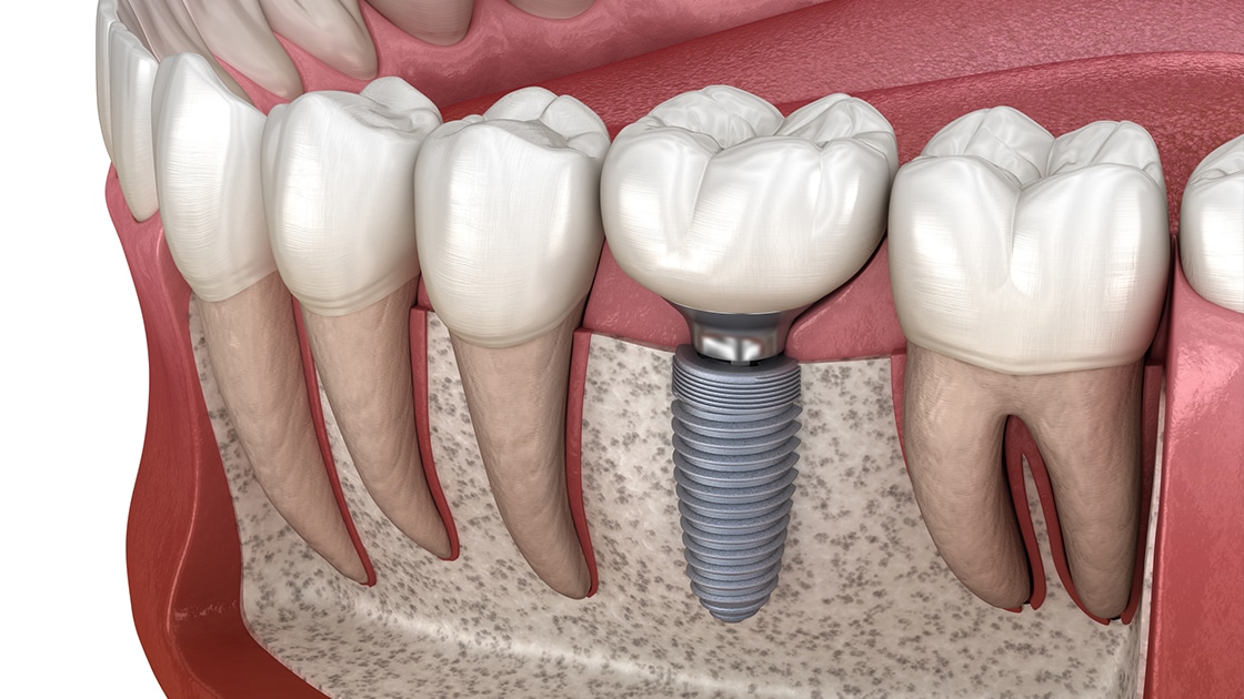 ایمپلنت دندان و انواع روش های انجام آن