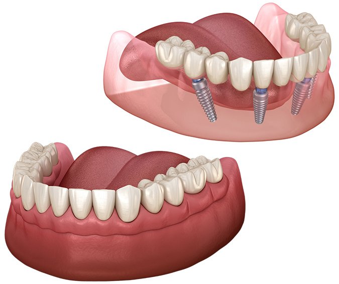 راه های کاهش هزینه ایمپلنت کامل دندان