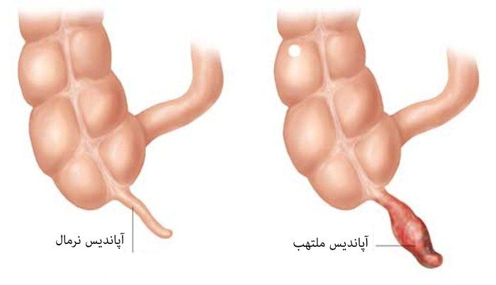 آپاندیس چیست و درمان آپاندیسیت چگونه است؟
