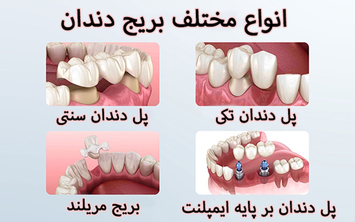 روش‌های مختلف بریج یا پل دندان