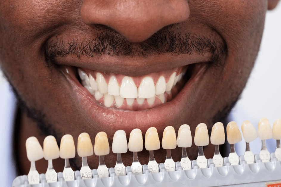 بهترین رنگ کامپوزیت دندان برای پوست تیره