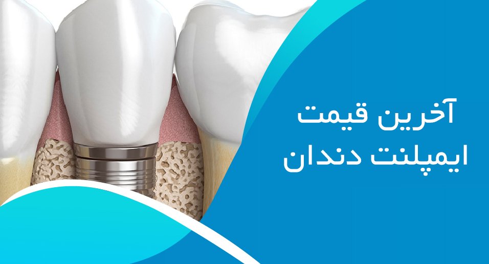 آخرین قیمت ایمپلنت دندان