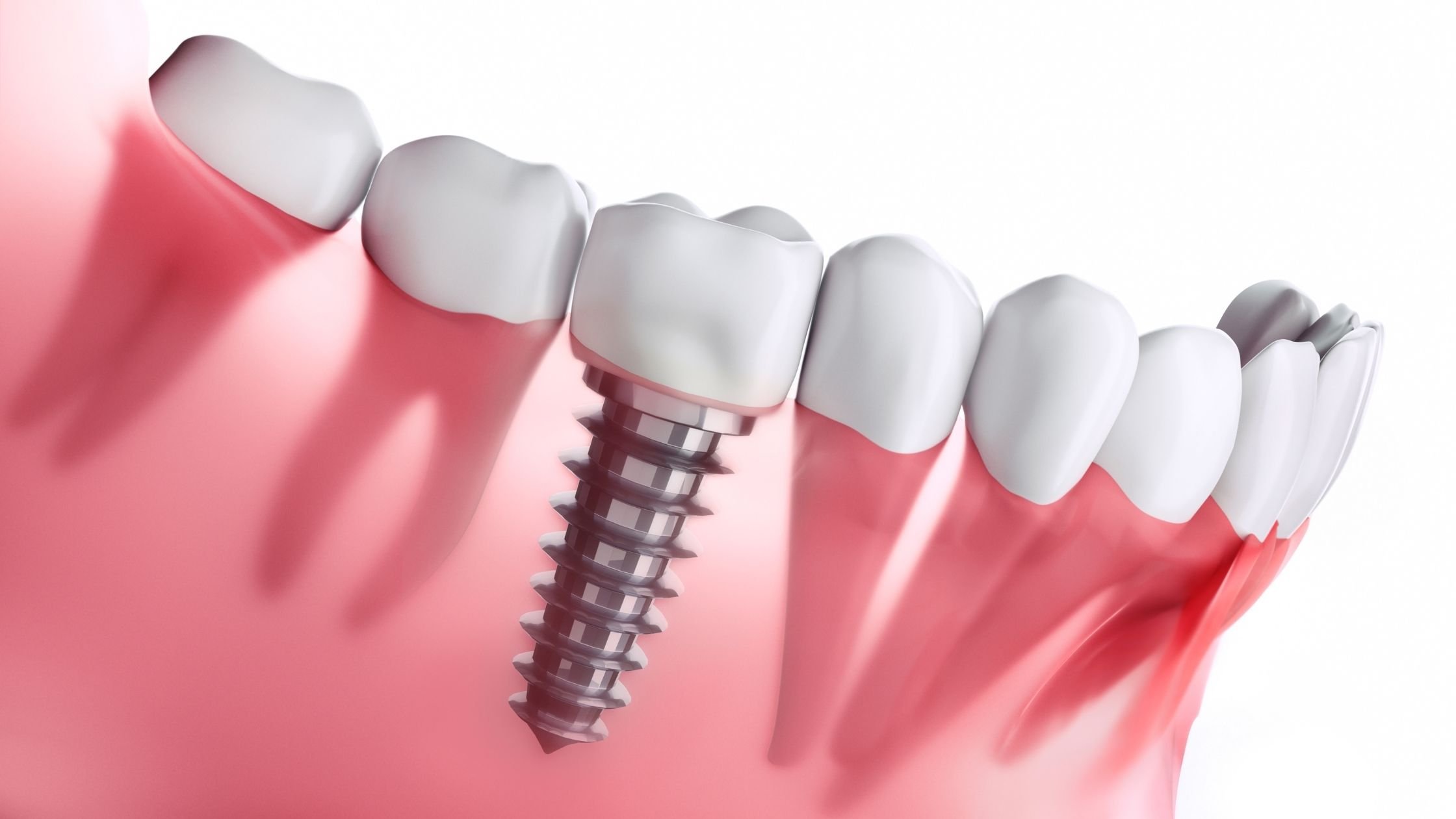 چرا ایمپلنت دندان پوسیده نمی شود ؟