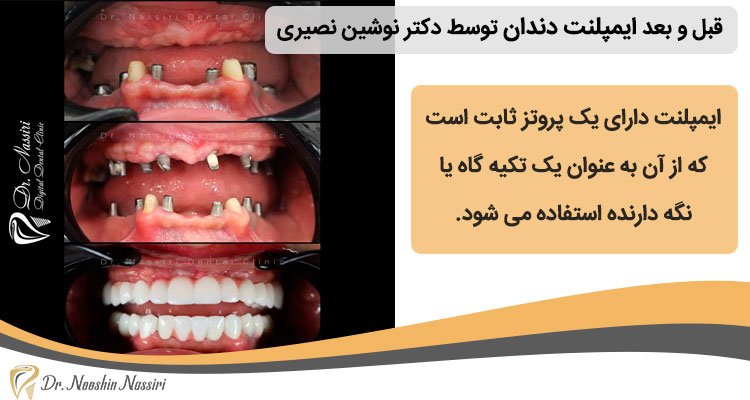 عکس قبل و بعد ایمپلنت دندان