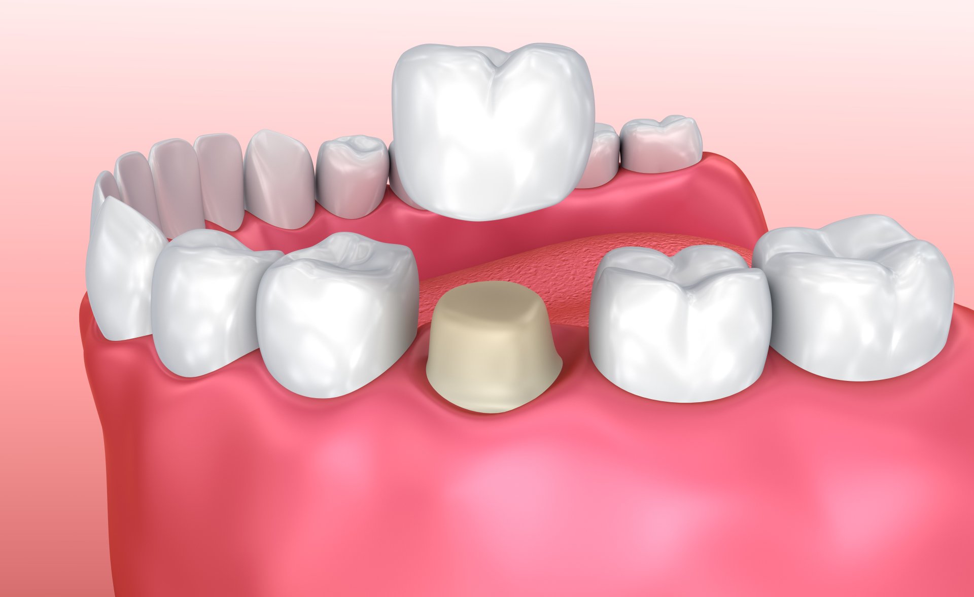 روکش دندان چیست