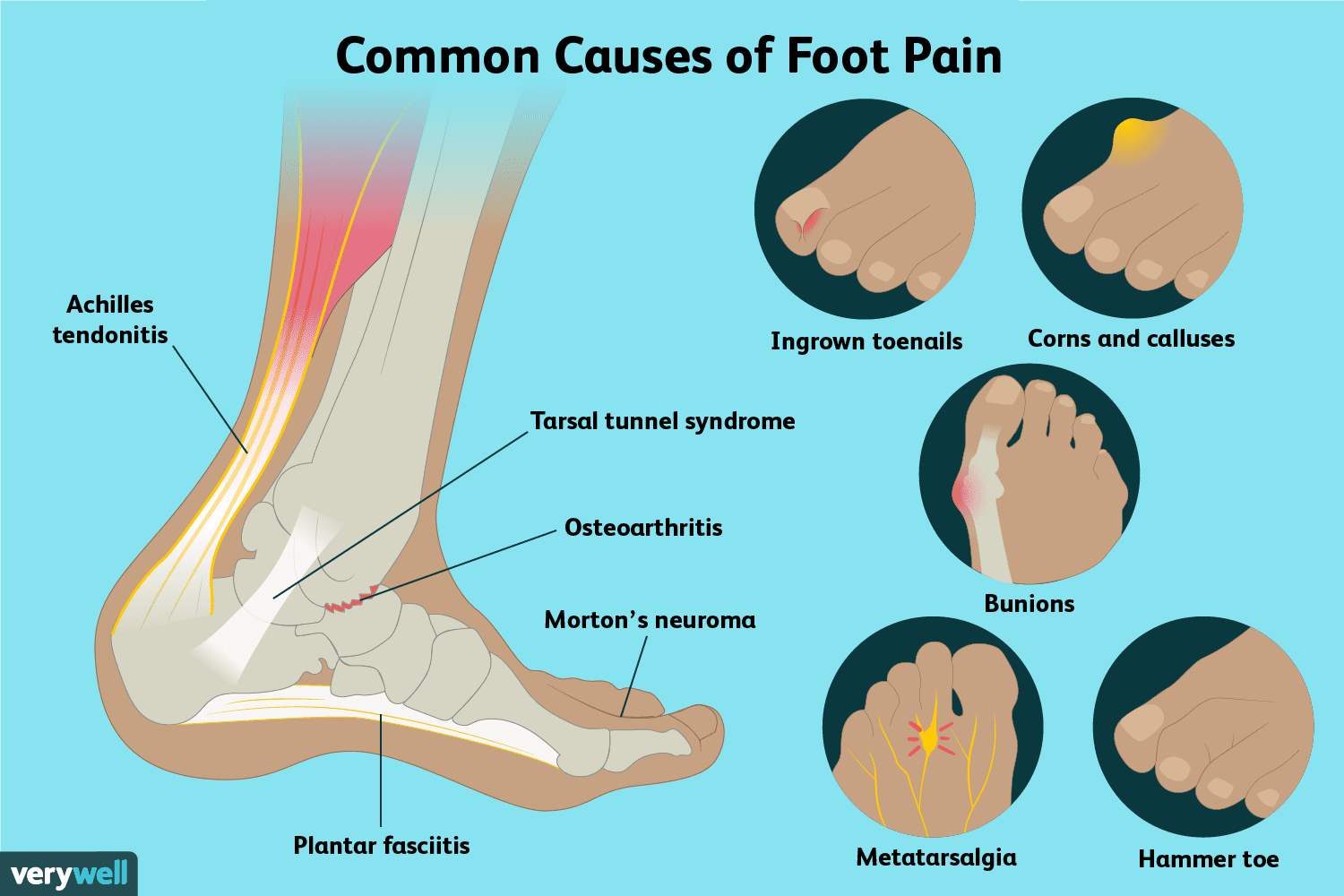 درد کف پا نشانه چیست و چگونه درمان می‌شود؟