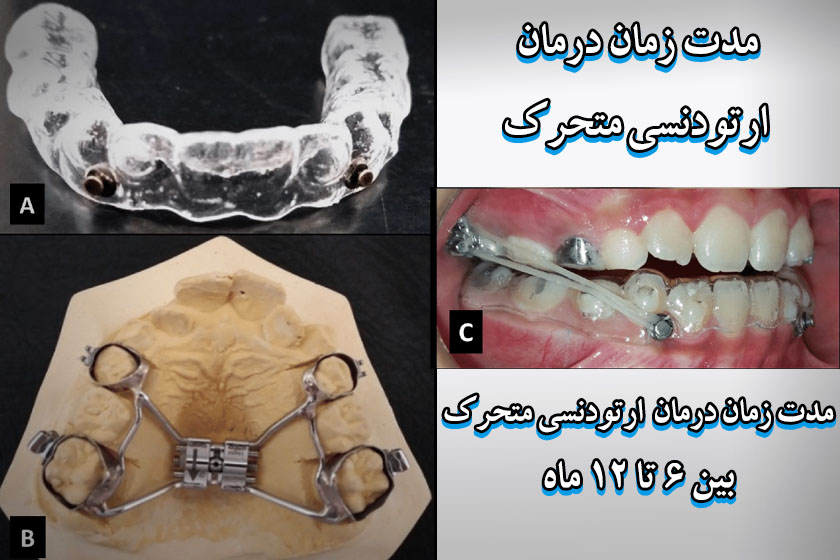 عکس ارتودنسی متحرک دندان
