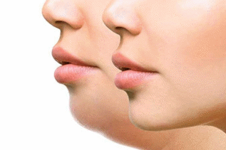 دوره نقاهت ساکشن غبغب Shape3