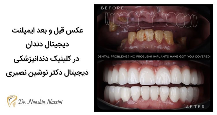 عکس قبل و بعد ایمپلنت دیجیتال دندان
