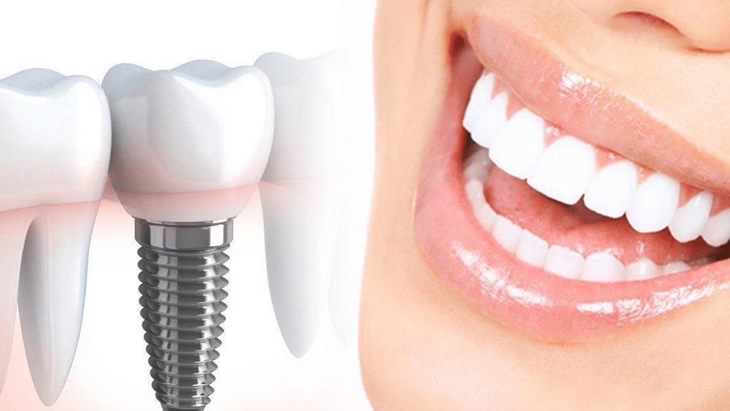 بهترین مرکز ایمپلنت دندان
