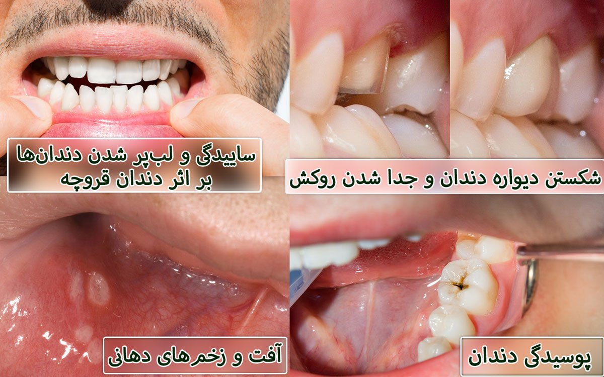 بیماری‌های دهان و دندان به دلیل کاهش سیستم ایمنی