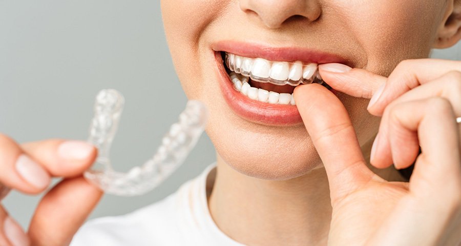 بلیچینگ دندان چیست؟ ( شاپ دنت )