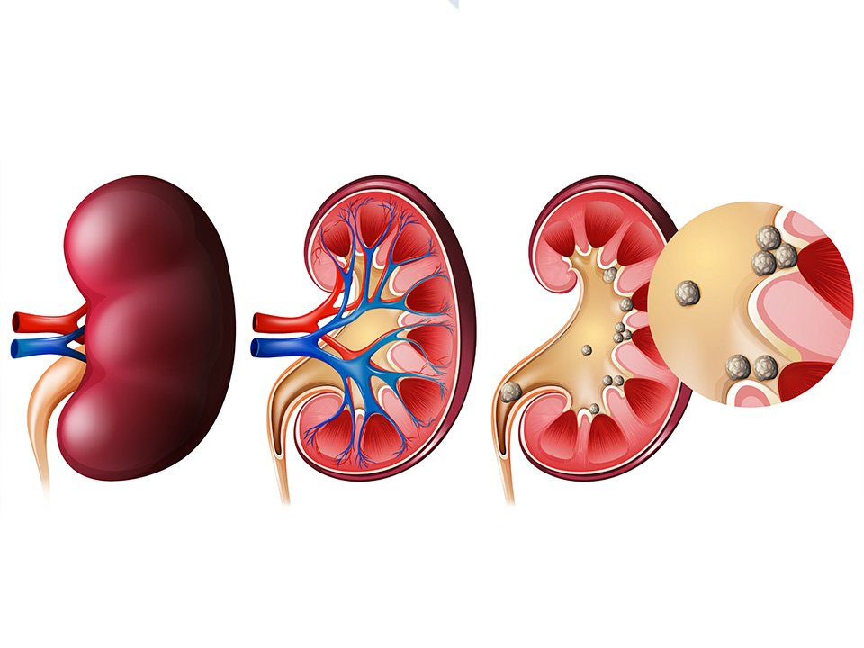 تصویر از درمان سنگ کلیه با بهترین دستگاه تصفیه آب