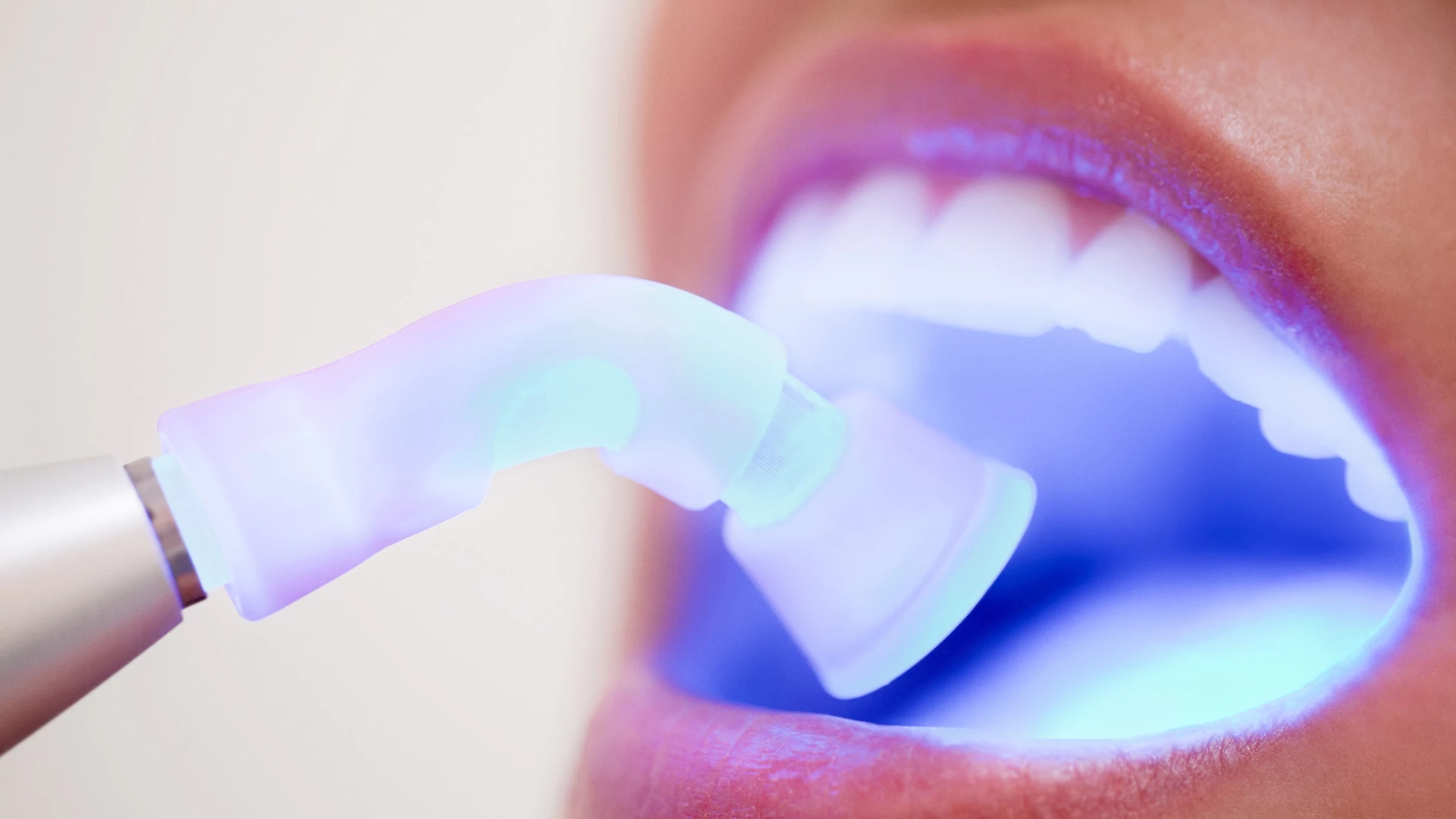 فرآیند اجرای کامپوزیت دندان