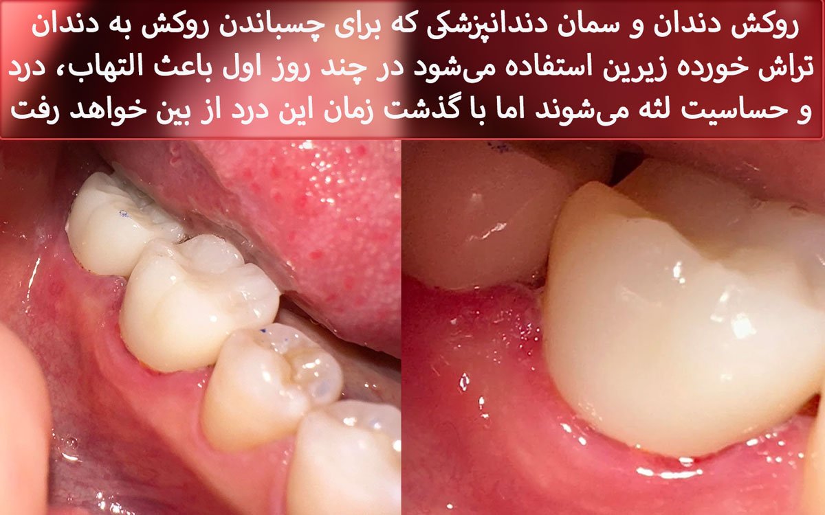 التهاب لثه اطزاف روکش دندان