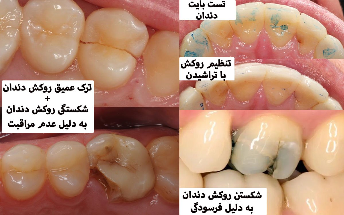 درمان درد دندان بعد از روکش