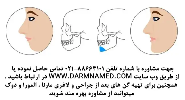 پروتز چانه چیست