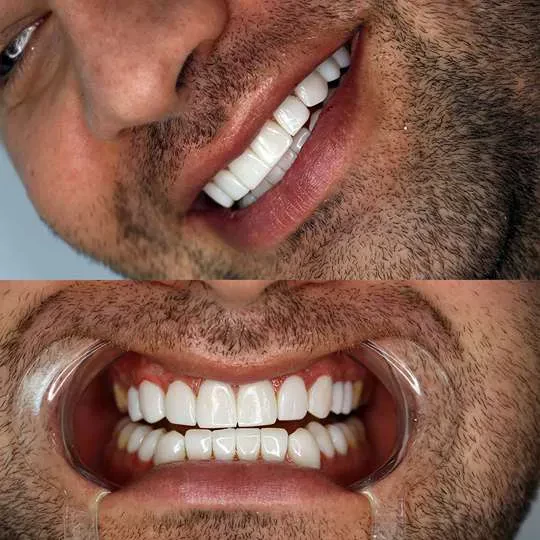 لمینت دندان