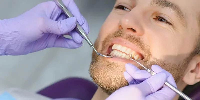 کامپوزیت دندان برای سفید کردن دندان