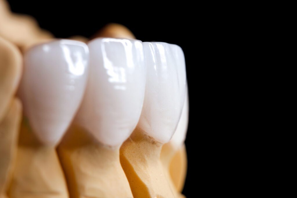 سن مناسب لمینت دندان، چند سال است؟