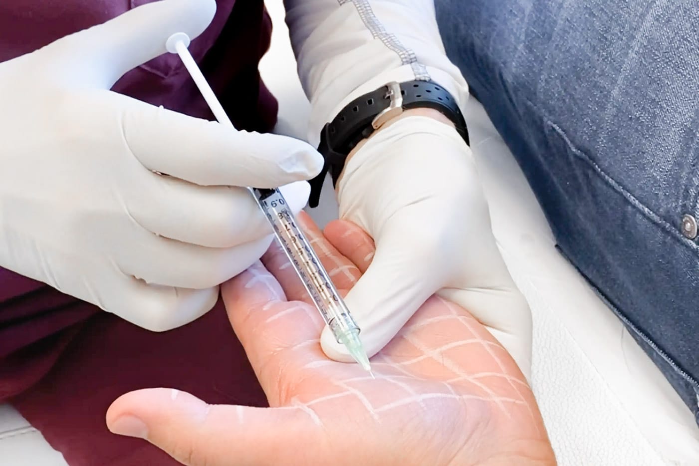 قیمت بوتاکس کف دست تهران