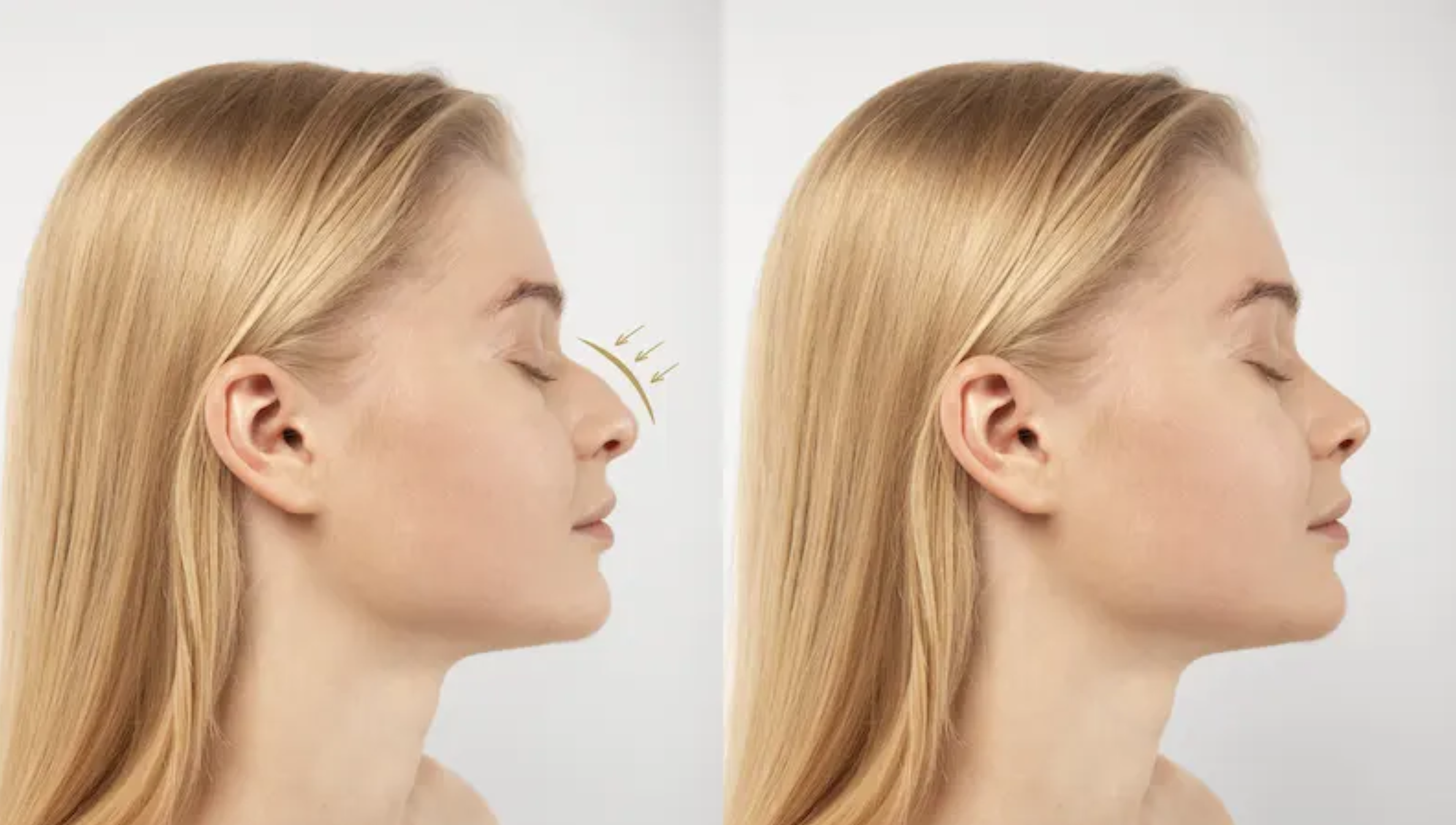 بهترین جراح عمل بینی نیمه فانتزی در تهران