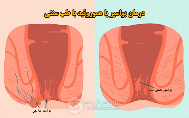 علائم و درمان بواسیر یا هموروئید چیست؟ درمان بواسیر یا هموروئید با طب سنتی