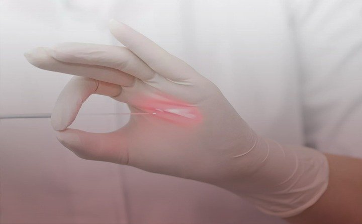 لیزر بواسیر