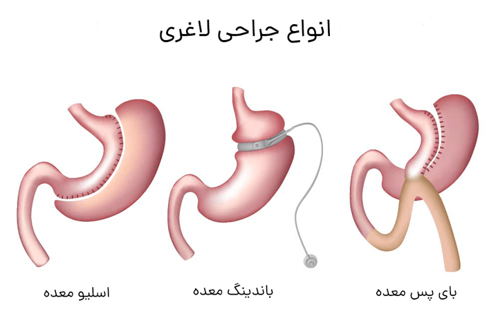 جراحی های لاغری