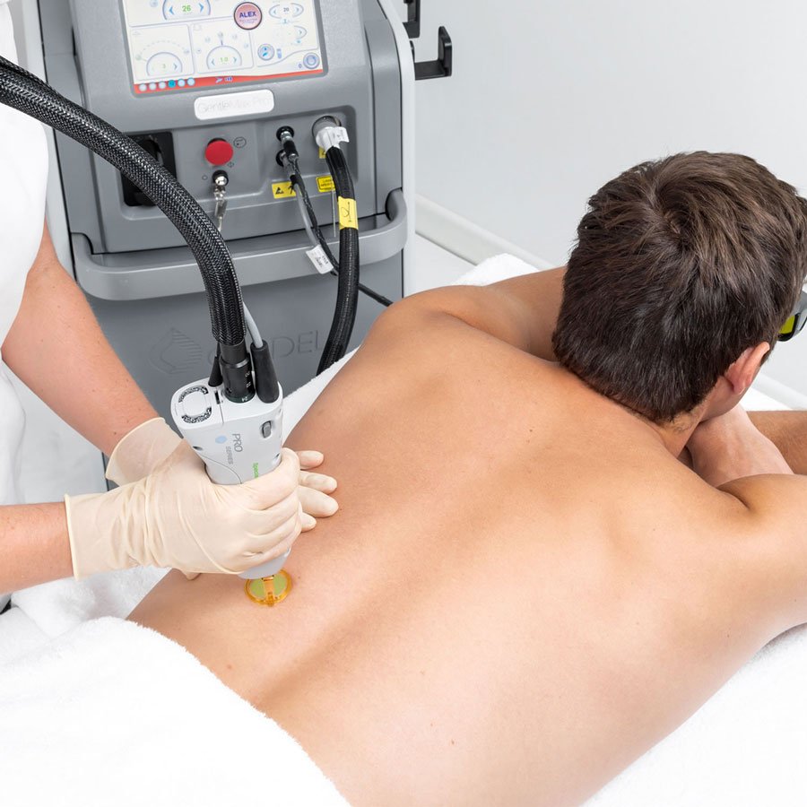 لیزر موهای زائد