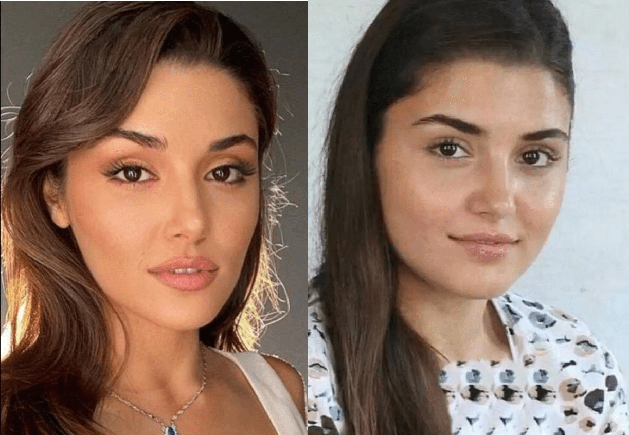 عمل زیبایی هانده ارچل | تغییرات زیبایی قبل و بعد از عمل 1 تزریق فیلر چانه هانده ارچل