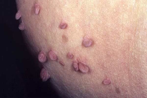 زگیل تناسلی چیست؟