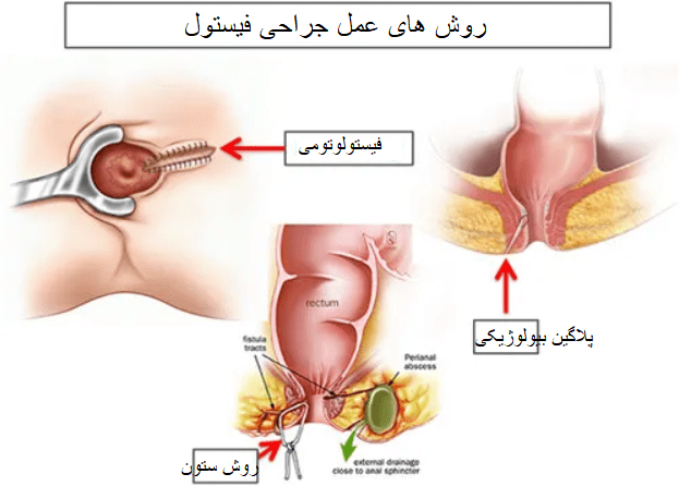 روش های جراحی فیستول