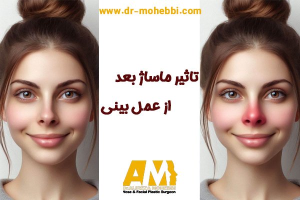 ماساژ بعد از جراحی بینی