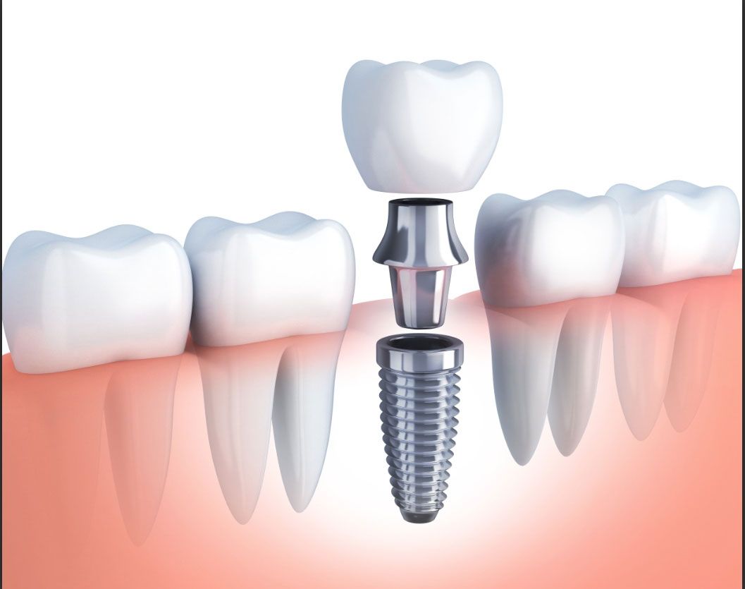 ایمپلنت دندان - بهترین روش جایگزینی دندان از دست رفته