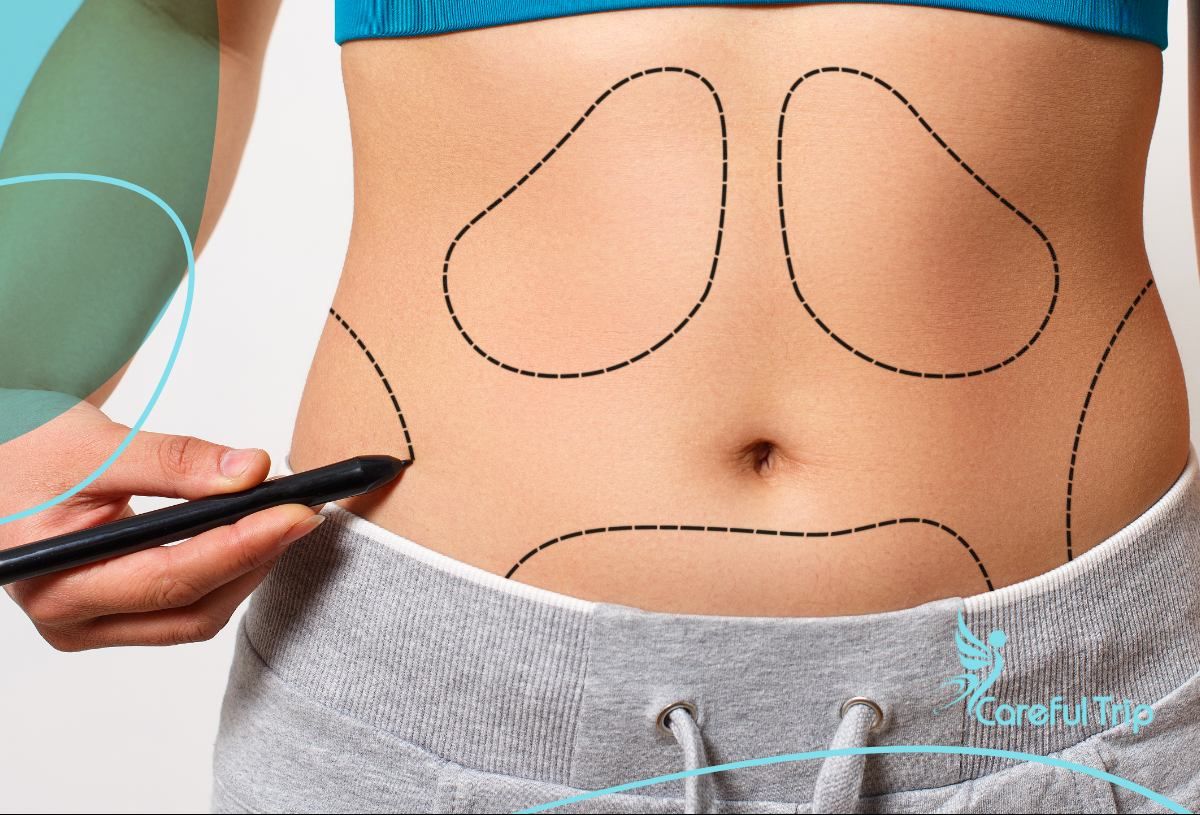 Liposuction In Iran